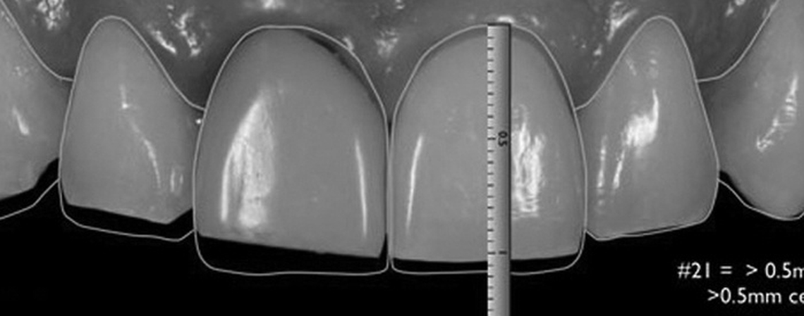 The Esthetic and Functional Rehabilitation of Compromised Dentition: Analog versus Digital Technologies