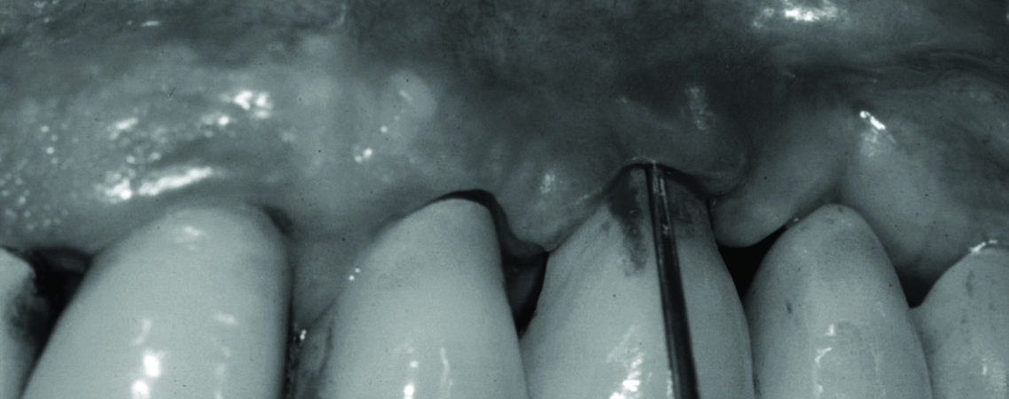 Ideal maintenance for the implant patient