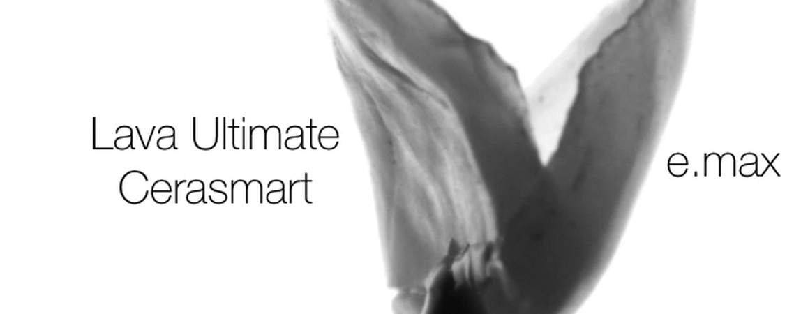 Smile Design & Worn Dentition: Recipes for Repeatable and Predictable Everyday Dentistry