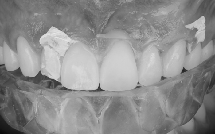 Aesthetic Zone with Flowables