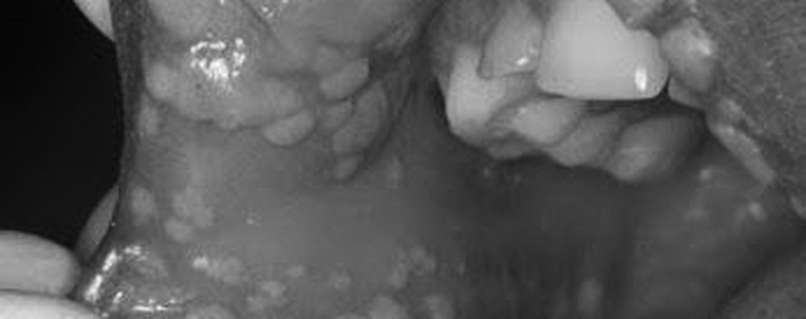 HPV - It is not the Hanky Panky Virus the media says it is: Oral Abnormality Screening and the Health Care Provider