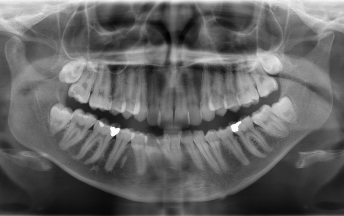 Radiographic Interpretation: Getting the Most out of Dental Radiographs.