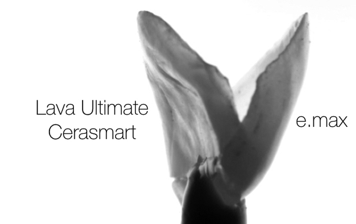 Smile Design & Worn Dentition: Recipes for Repeatable and Predictable Everyday Dentistry