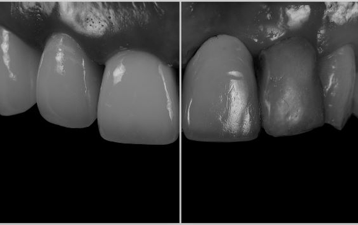 Natural Tooth Soft Tissue Treatment Technology