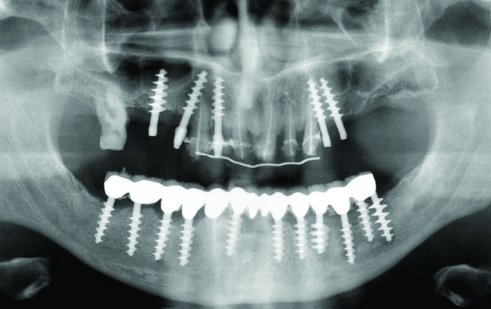Dental Implants: Successful Assessment and Maintenance for Lifelong Oral Health