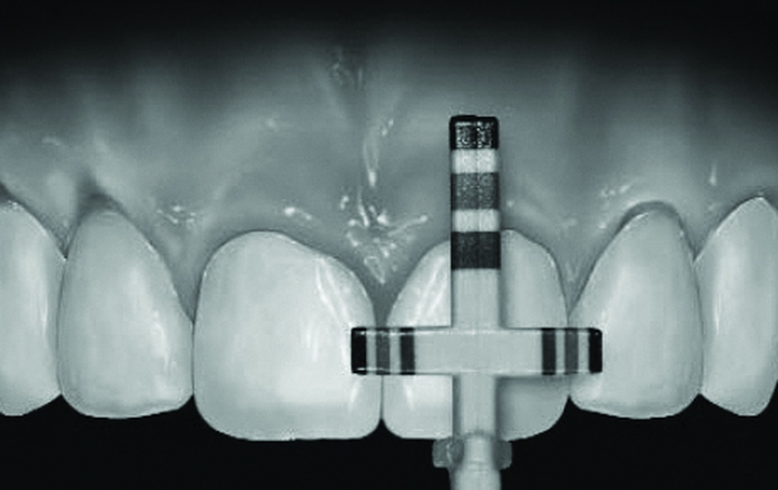 Clinical Considerations for Posterior and Anterior Crown lengthening
