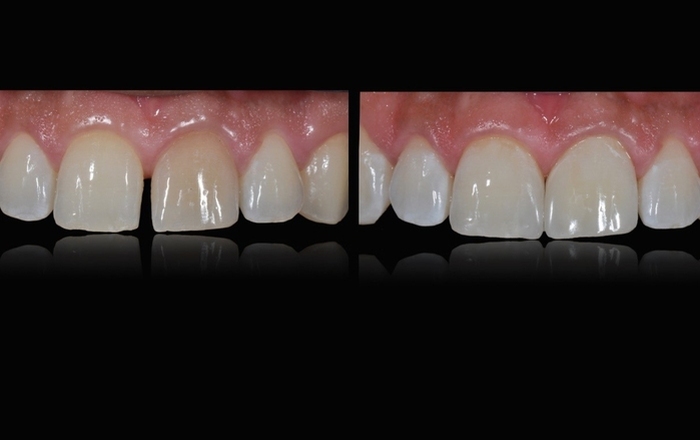 MicroVision Aesthetics All About Veneers: Full Course from Smile Design, Lab Communication, Isolation to Bonding
