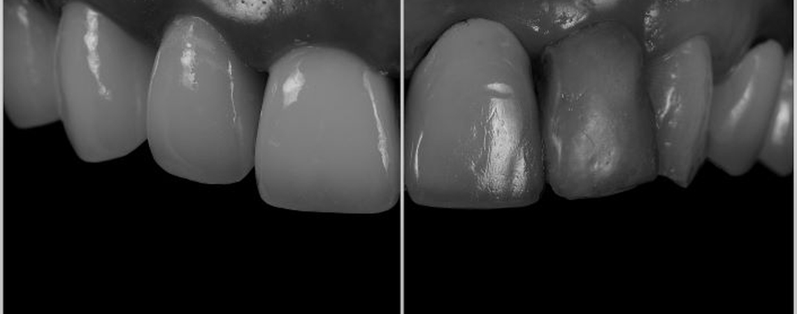 Natural Tooth Soft Tissue Treatment Technology