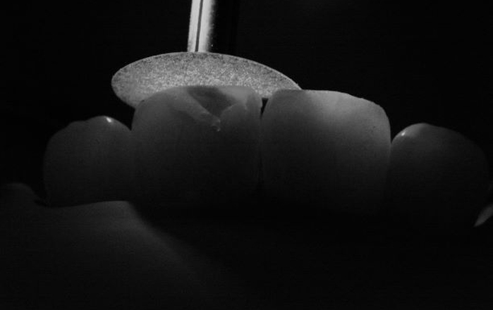 When To Do What: From Direct To Indirect Restoration In Styleitaliano