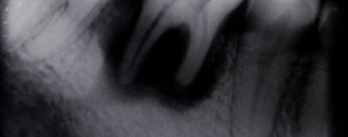 Differentiating the Different Types of Resorption