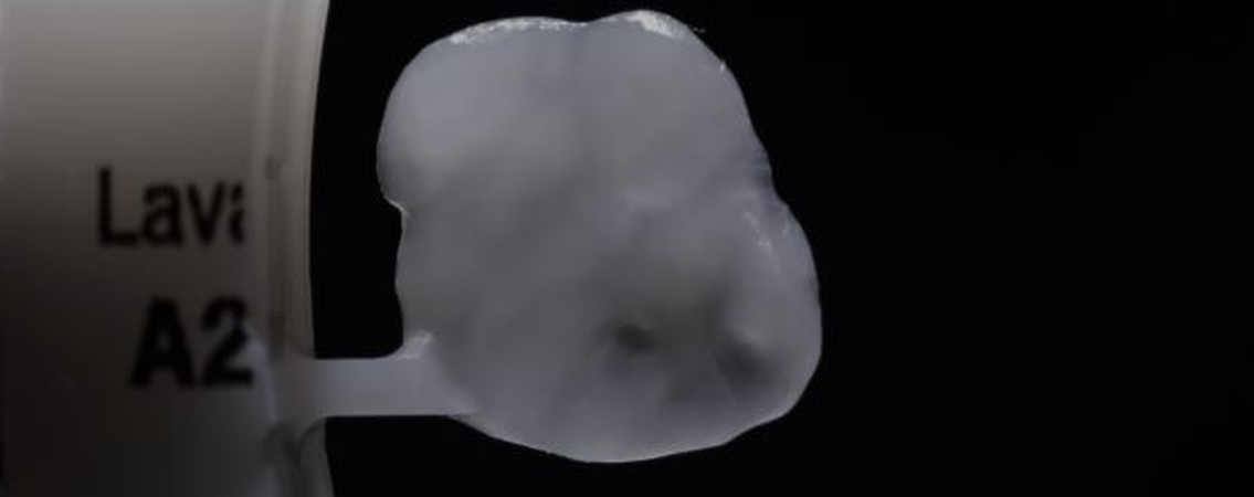 Simplified Treatment of Severe Dental Erosion with Ultra-Thin CAD/CAM Occlusal Veneers