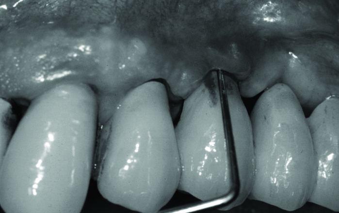 Ideal maintenance for the implant patient