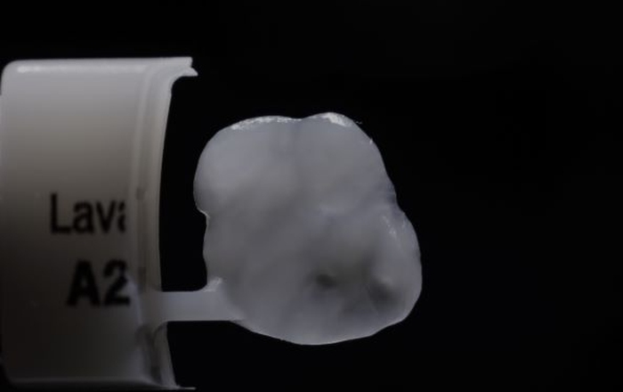 Simplified Treatment of Severe Dental Erosion with Ultra-Thin CAD/CAM Occlusal Veneers