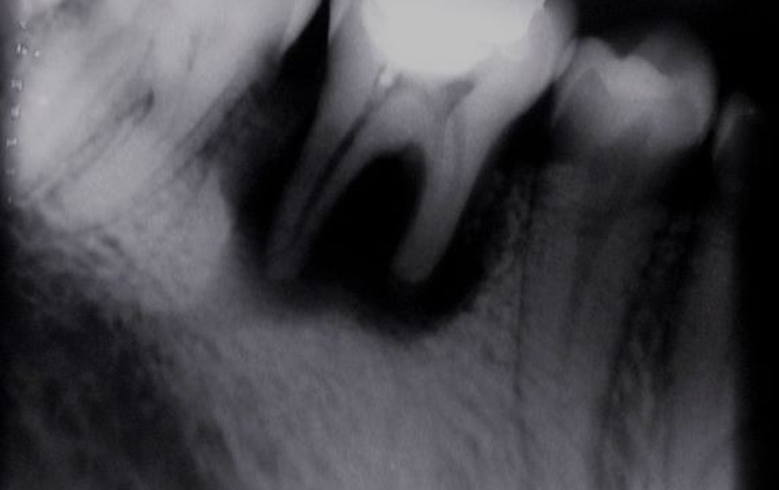 Differentiating the Different Types of Resorption