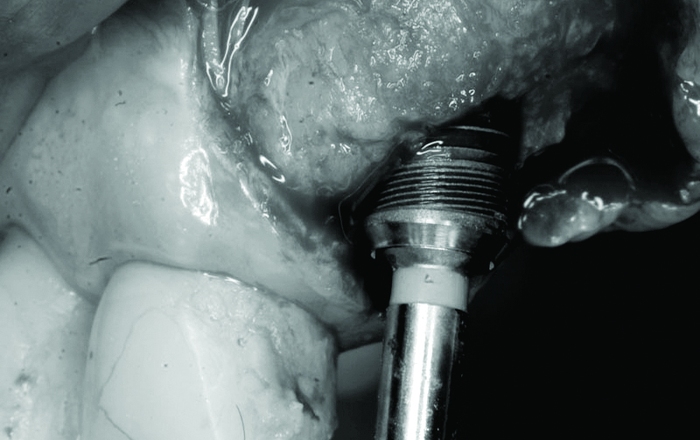 To Bleach or Not to Bleach: All the Modern Techniques of Dental Bleaching in Association with Prosthetic Treatments