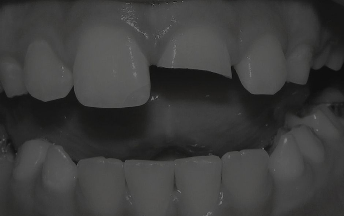 Demystifying Tooth Resorption