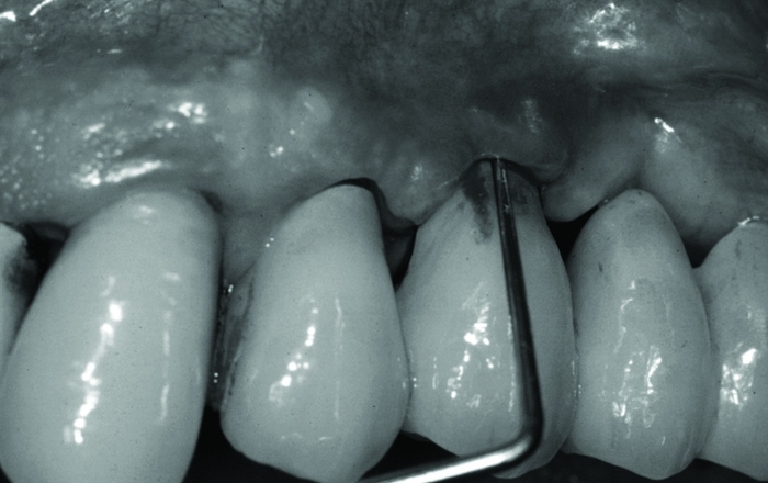 Ideal maintenance for the implant patient