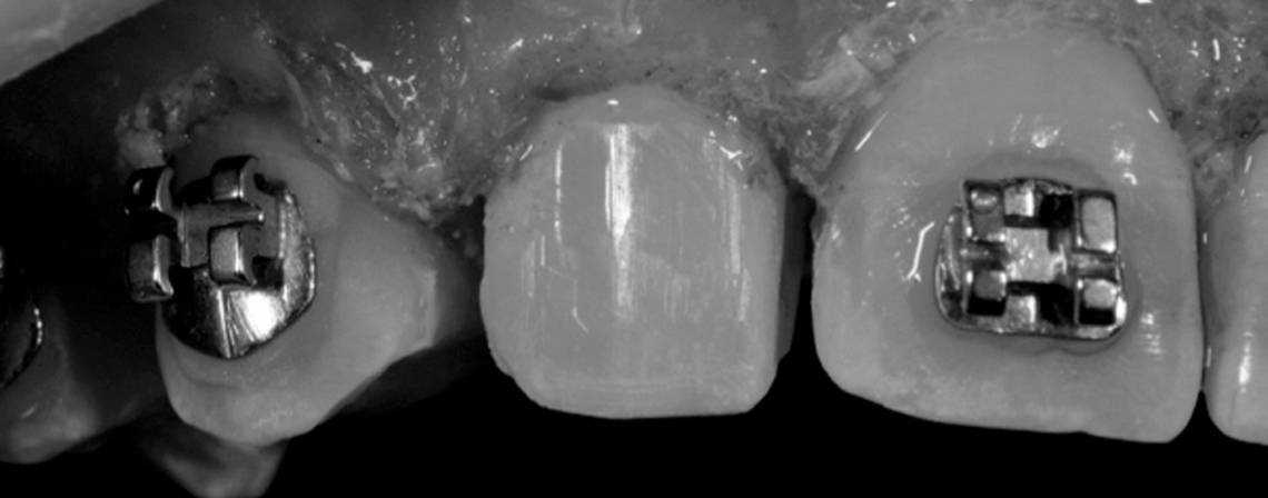 Enameloplasty and Aesthetic Finishing in Orthodontics