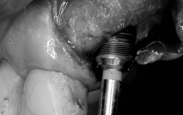 Optimal Treatment Planning in  Implant Dentistry