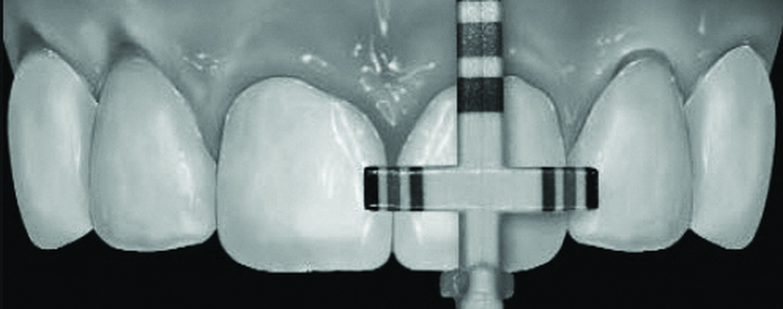 Clinical Considerations for Posterior and Anterior Crown lengthening