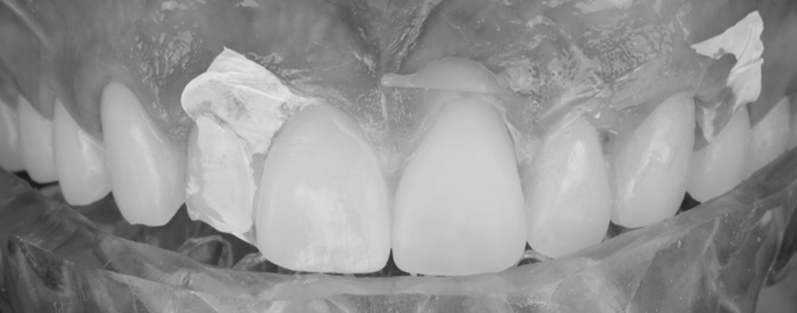 Aesthetic Zone with Flowables