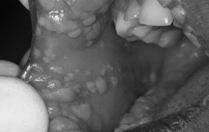 HPV - It is not the Hanky Panky Virus the media says it is: Oral Abnormality Screening and the Health Care Provider