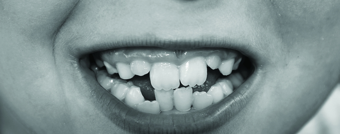 Identifying the causes of malocclusion